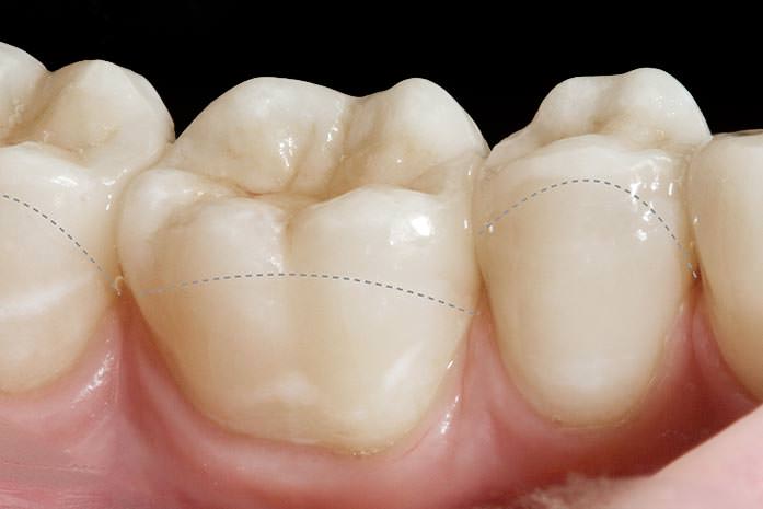 Teilkronen für widerstandsfähige, zierliche Zahnrekonstruktionen. / Dr. Rüdiger Hansen, Zahnarzt München